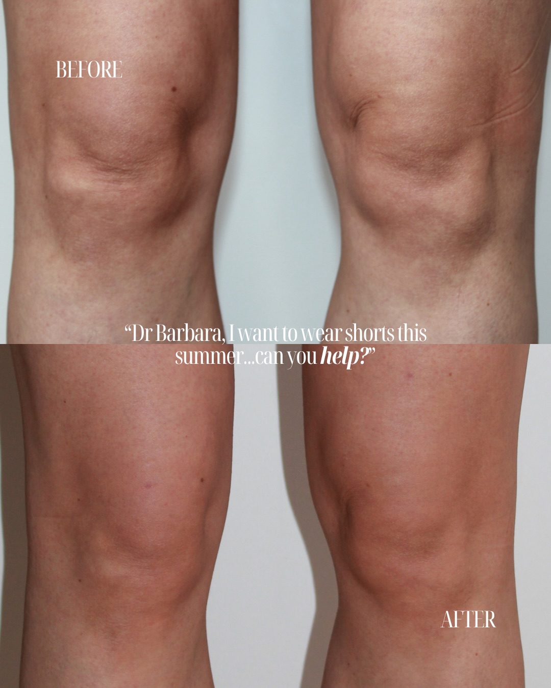 “Dr Barbara, I want to wear shorts this summer... can you help?”
It’s a question I hear more often than you might think