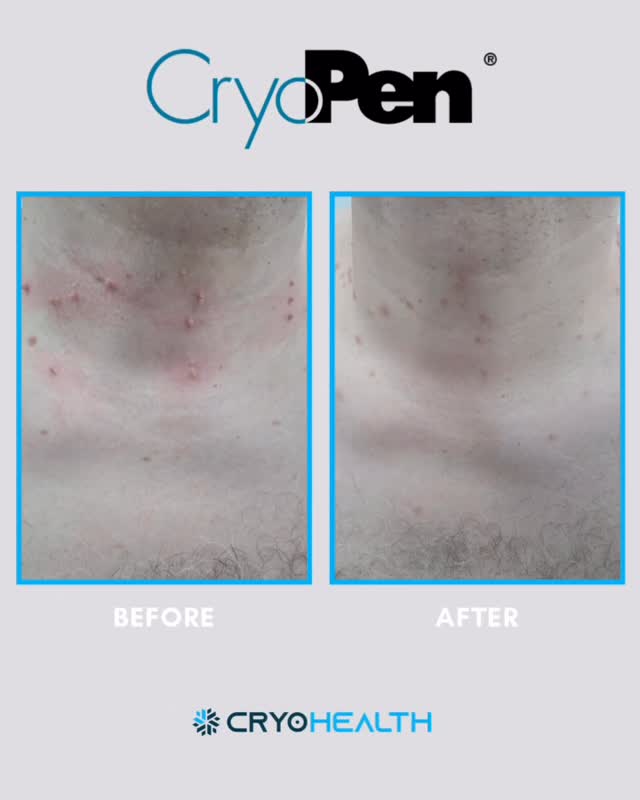 Say goodbye to pesky skin tags 👋🏽

These before & afters speak for themselves ✨

CryoPen treatment targets unwanted skin