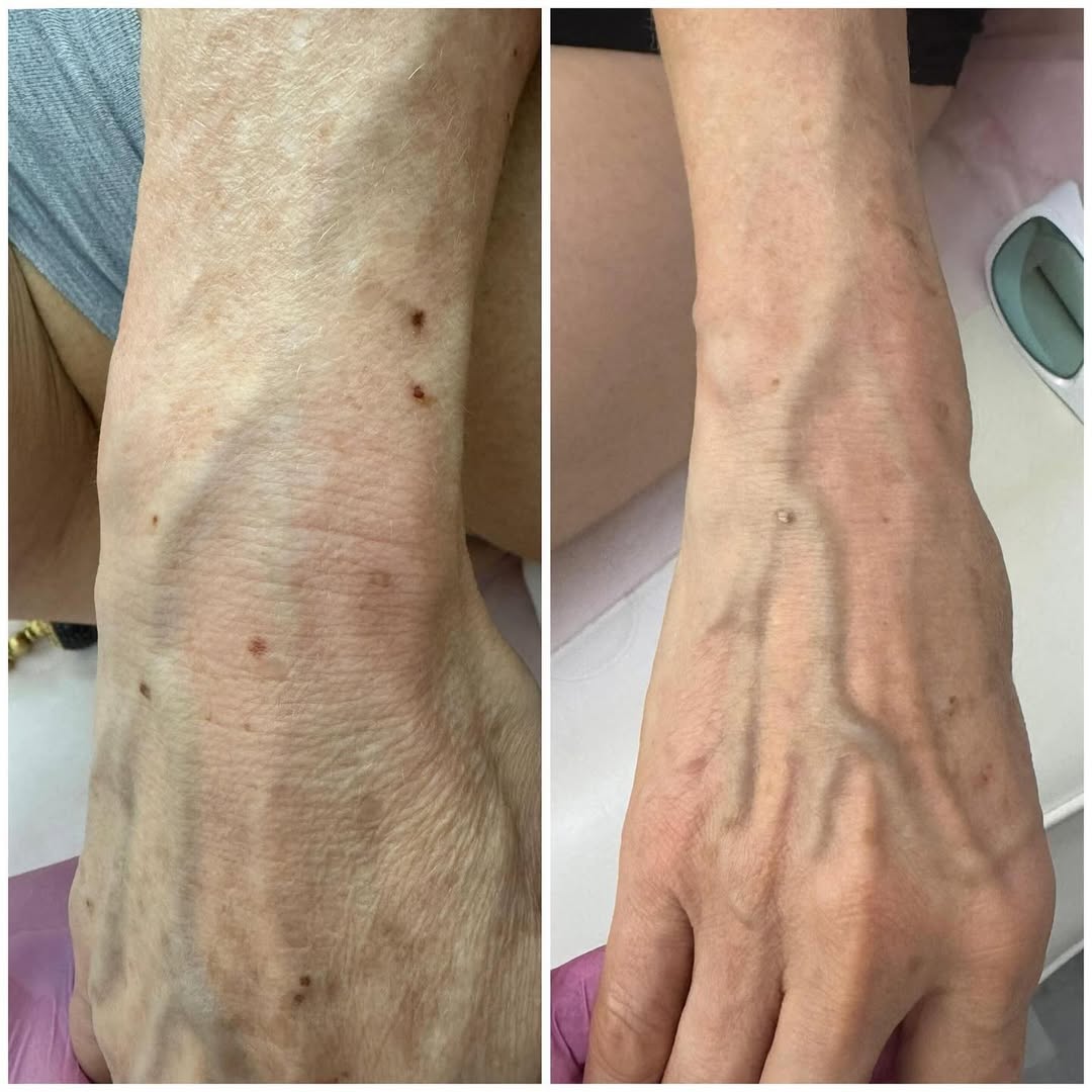 Age spots gone after 2 sessions with Aerolase laser! Painless, touch-less, no down time, no irritation! #agespots #laser