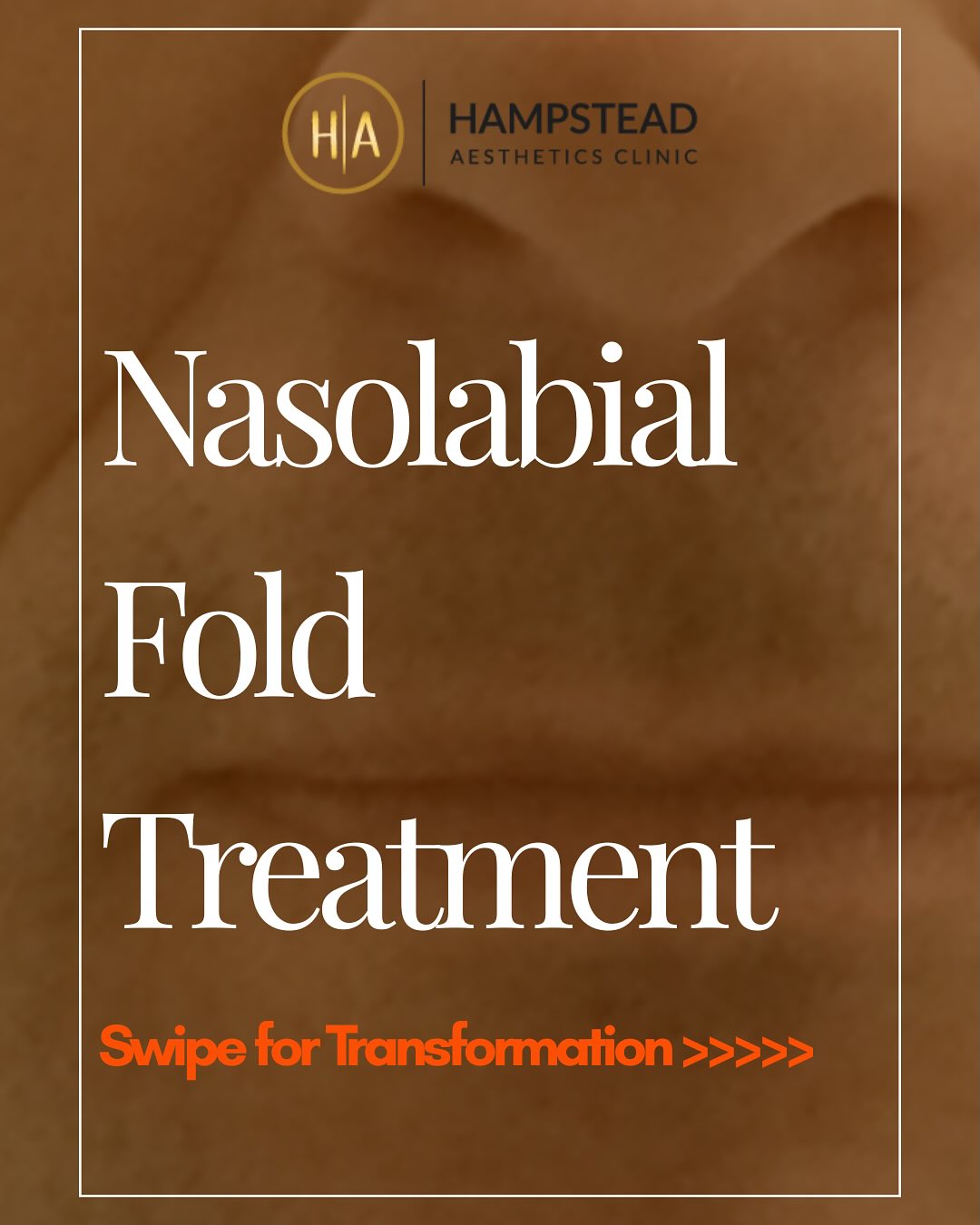 A natural refresh, without surgery. 💉✨
Nasolabial fold filler can soften deep smile lines and restore youthful volume,
