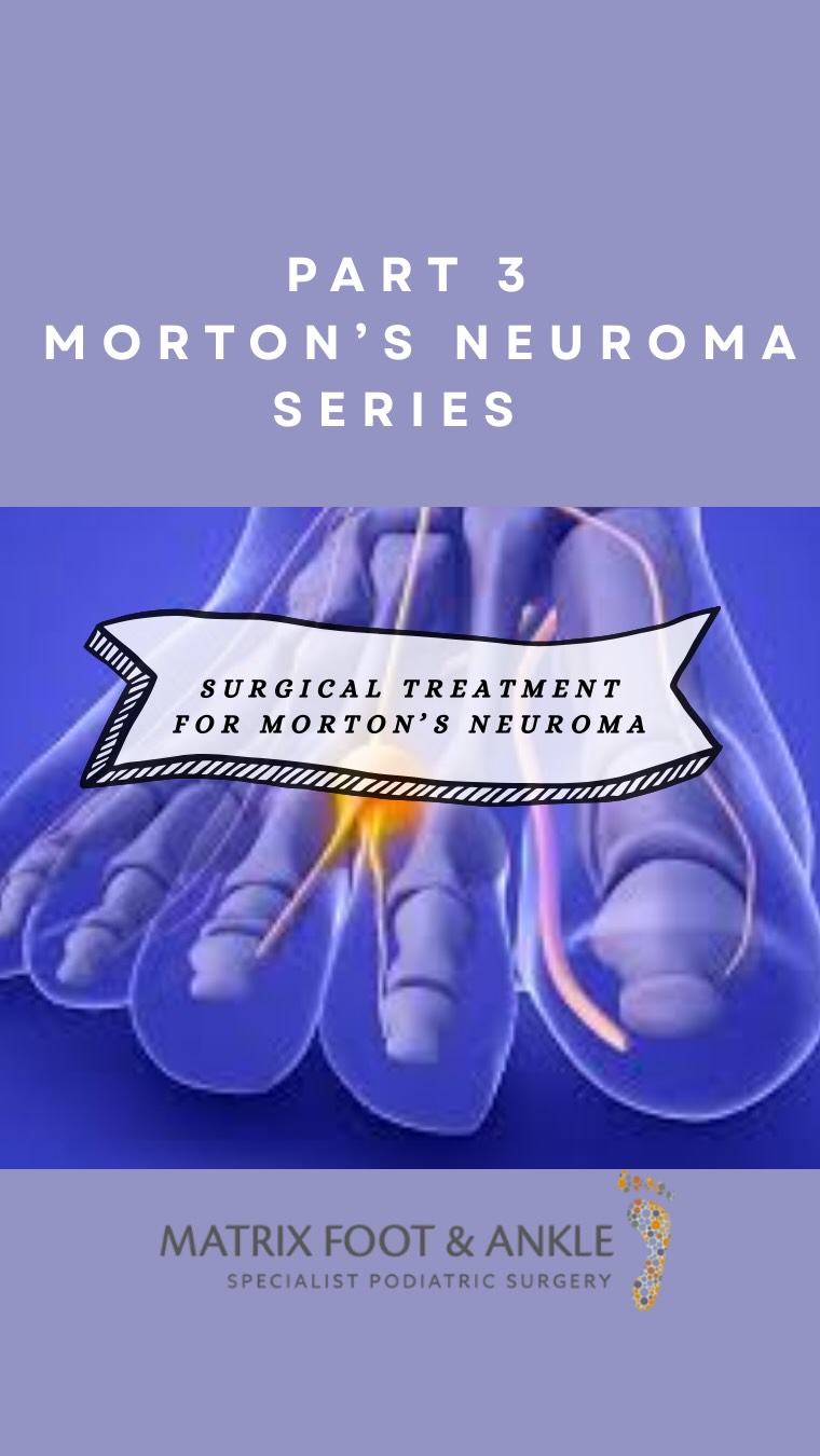Part 3 discusses on the Surgical procedure for Morton’s Neuroma. #mortonsneuroma #matrixfootandankle #harleystreetspecia