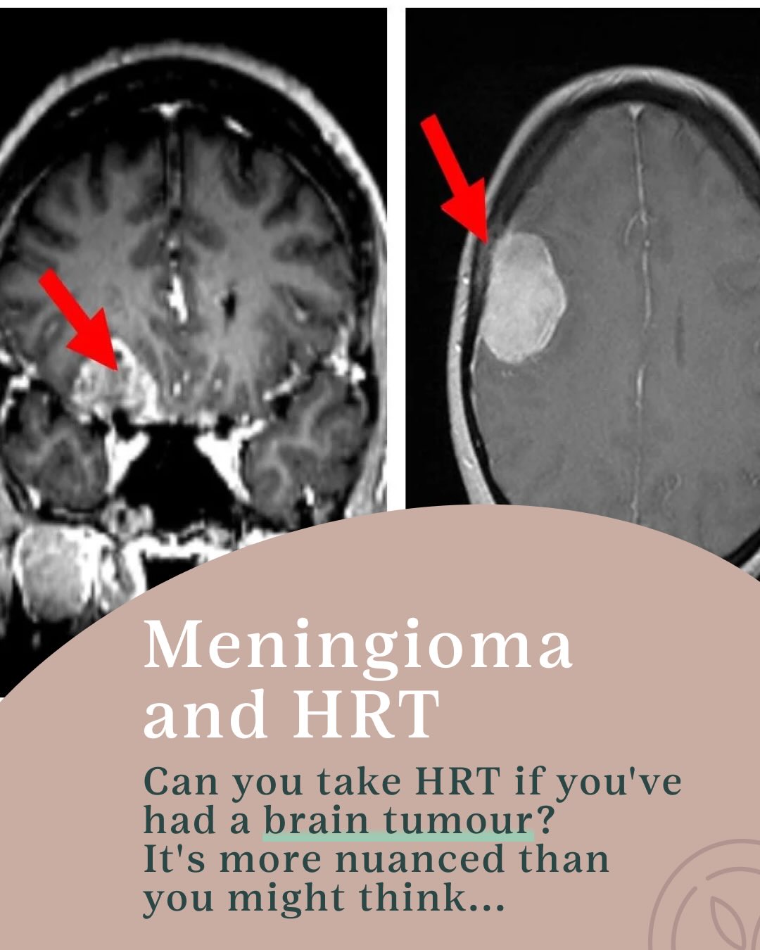 There has been a lot of concern about HRT and meningiomas.
So what does the research actually say?
Some hormone medica