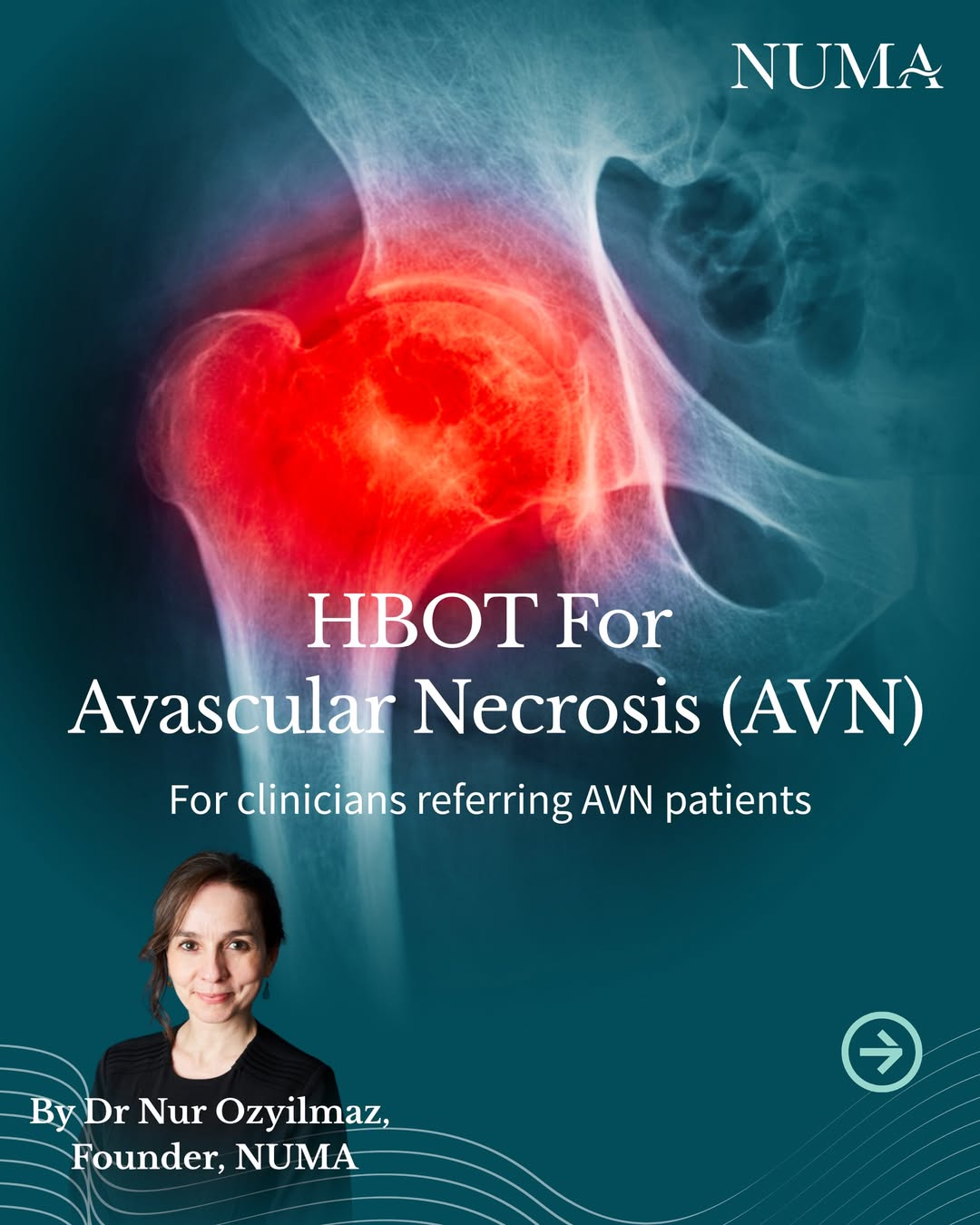 We're seeing a growing number of referrals for avascular necrosis (AVN), so I wanted to summarise where the current med