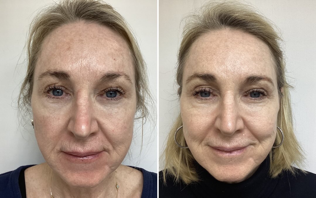 Not every treatment delivers like this. HALO + BBL for texture, pigmentation and that lit-from-within glow. Real patient
