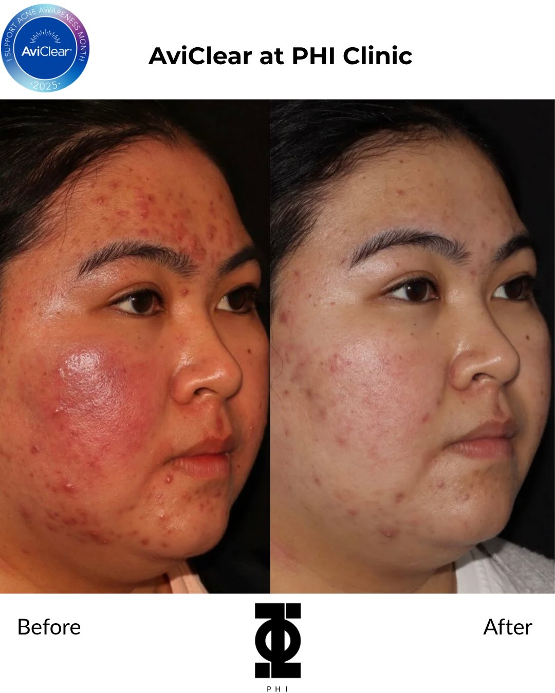 If you’ve ever struggled with acne, you’ll know it’s about so much more than just your skin.

There are good days, diffi