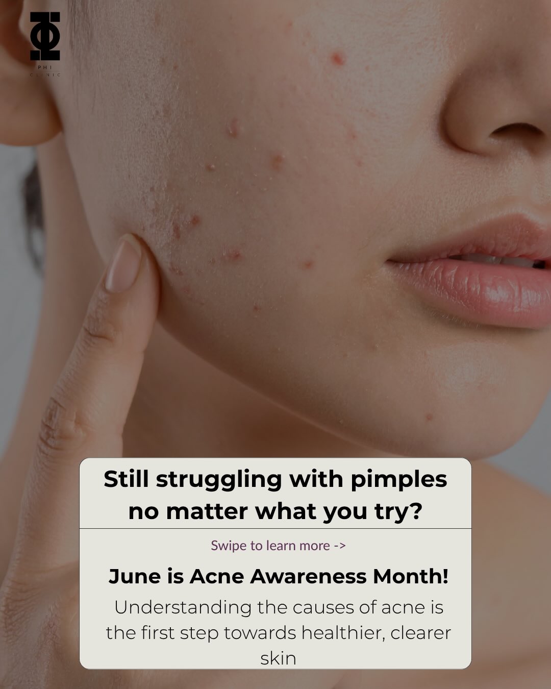 June is Acne Awareness Month 💙

Acne is one of the most common skin conditions worldwide, yet many people continue to st