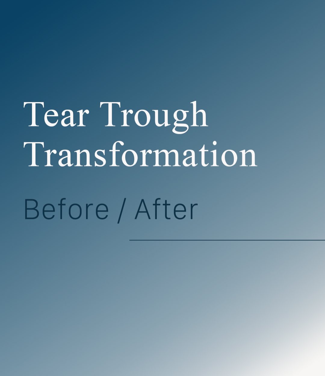 Tear trough transformation ✨
“Under eye filler is scary” is one of the most common myths we hear but when it is done cor