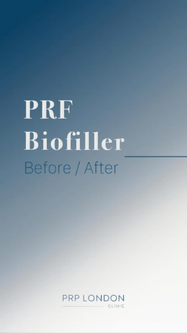 Before ➡️ After ✨
Under eyes refreshed with PRF biofiller for a natural, brighter look using your body’s own regenerativ