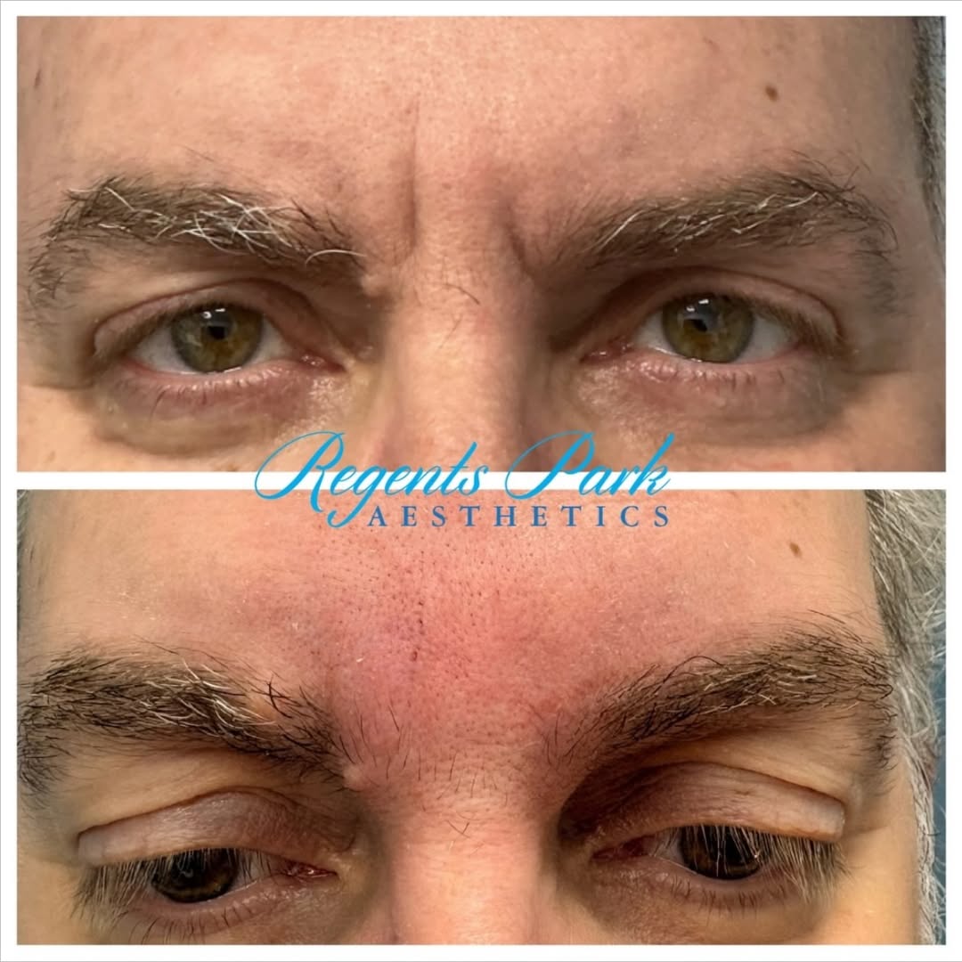 An instant face refresh, with zero downtime 🙏
Frown lines (or 11 lines) aren’t just about expression - they can make yo