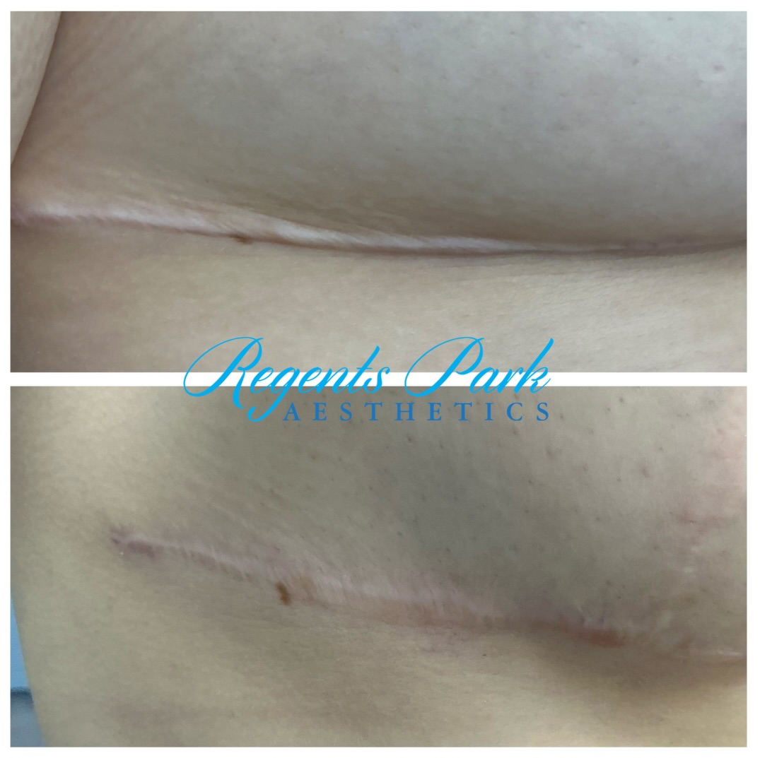 Amazing scar reduction results after just one session of CO2 laser ✨🤩👏
We’re so pleased to share this fantastic result