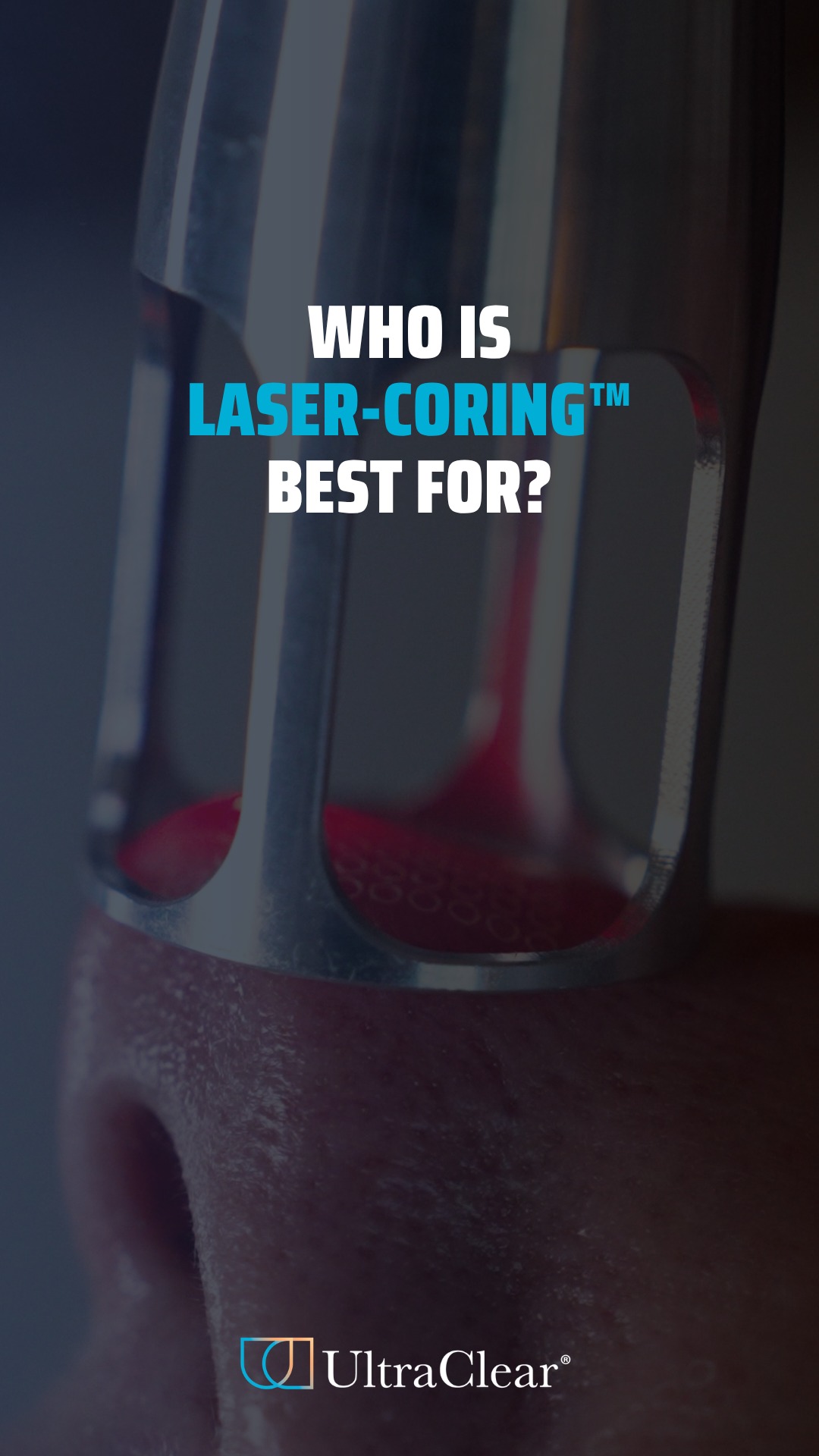 This UltraClear® laser technique isn't for everyone... and that's exactly the point.
Laser coring is a targeted mode de