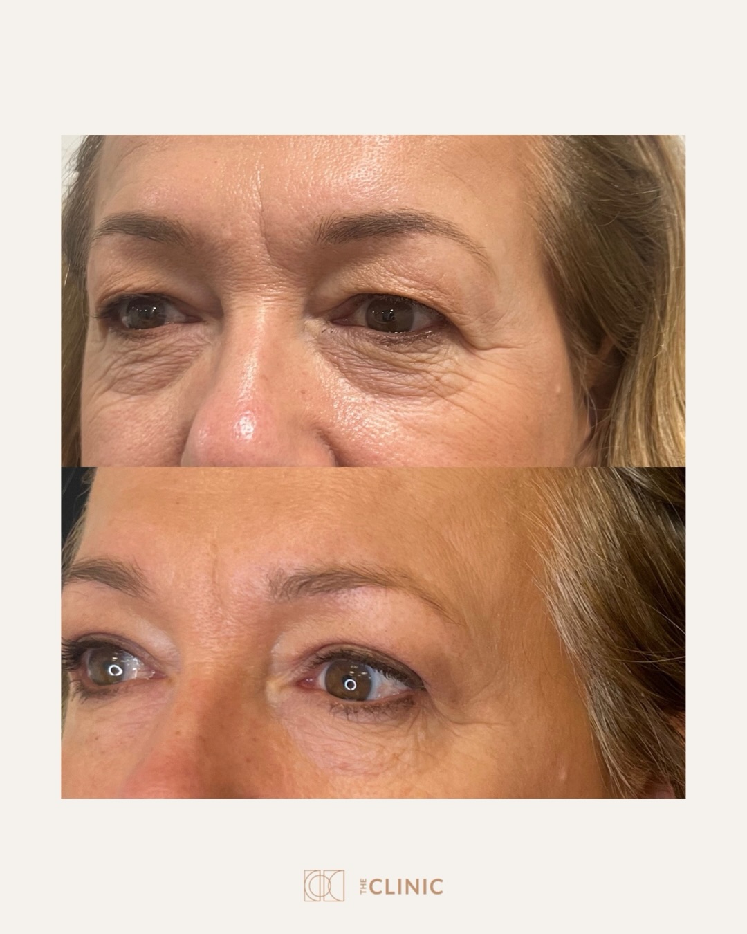 The eyes are often the first facial area to show ageing.
Blepharoplasty surgery at The Clinic Holland Park is designed